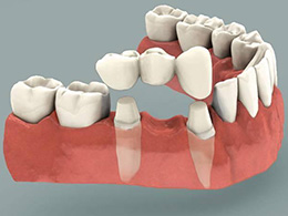 root canal treatment